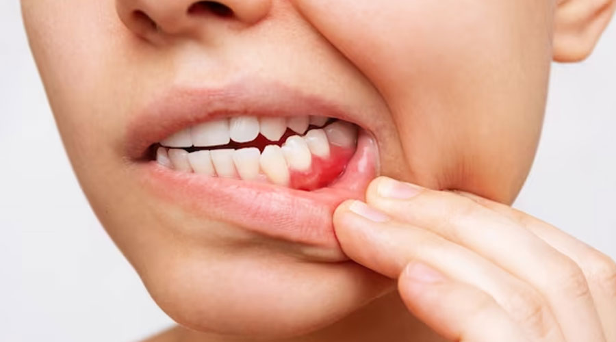 Cavities Myths & Facts