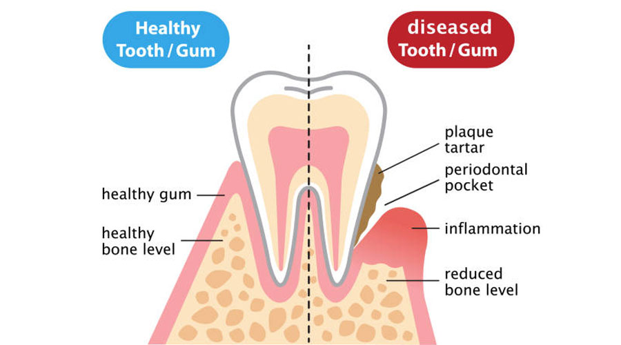 Symptoms & Treatment Of Gum Disease