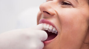 Inman-Aligner Or Invisalign Which To Choose