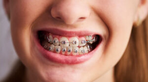 Orthodontic Treatment To Improve Your Smile