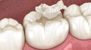 5 Benefits Of Tooth Coloured Fillings
