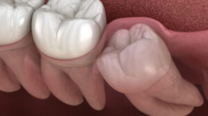 What Adults Should Expect During Wisdom Tooth Removal