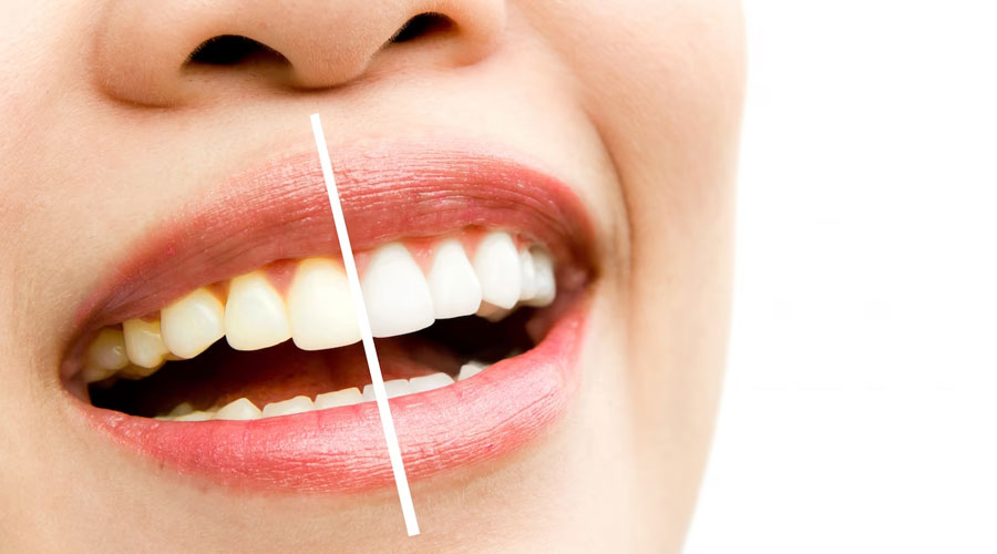 Tooth Whitening For Dental Hygiene!