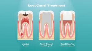 Types Of Root Canal Treatment