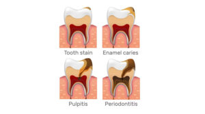 Different Types Of Cavities Affecting Your Teeth