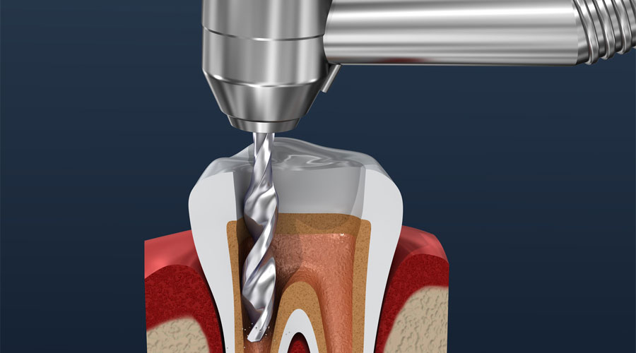 Know More About Root Canal Treatments